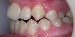 Фото до лечения - тесное положение зубов слева