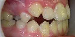 Фото до лечения - тесное положение зубов справа