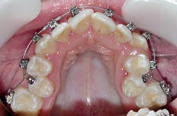 Фото до лечения - сужение верхнего зубного ряда