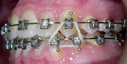В процессе лечения - тесное положение зубов слева