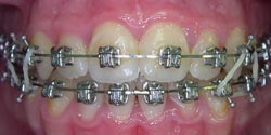 В процессе лечения - тесное положение зубов спереди