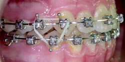 В процессе лечения - тесное положение зубов справа