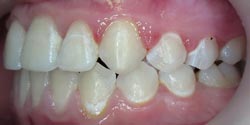 Фото после лечения - положение зубов слева