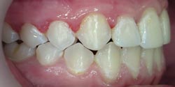 Фото после лечения - положение зубов справа