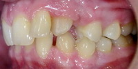 Зубы до лечения