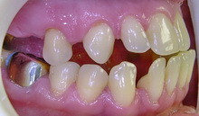 Зубы до лечения